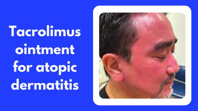 Tacrolimus ointment for atopic dermatitis